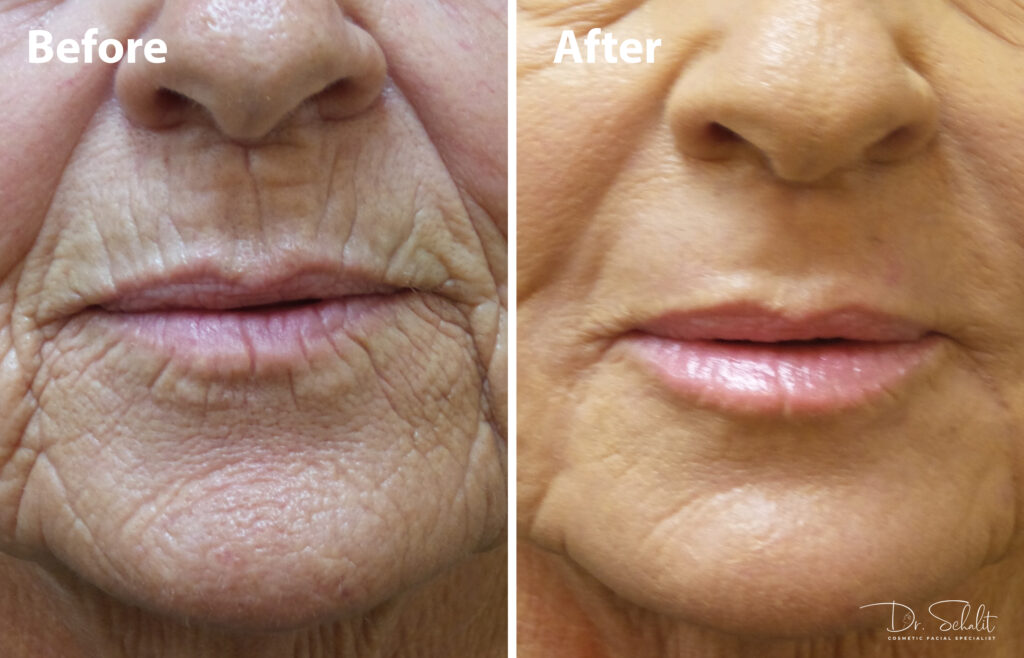 Erbium Yag Laser 1 Dr Schalit Cosmetic Facial Specialist