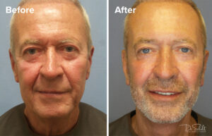 a man's face before and after a facelift in Daytona Beach with Dr. Schalit.