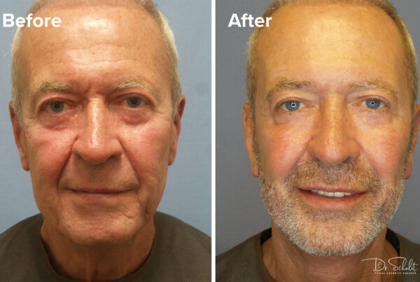 a man's face before and after a facelift in Daytona Beach with Dr. Schalit.