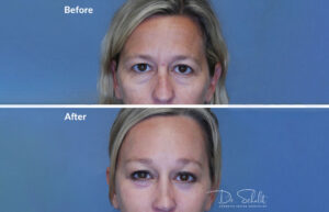 a woman's face before and after a facelift in Daytona Beach with Dr. Schalit.