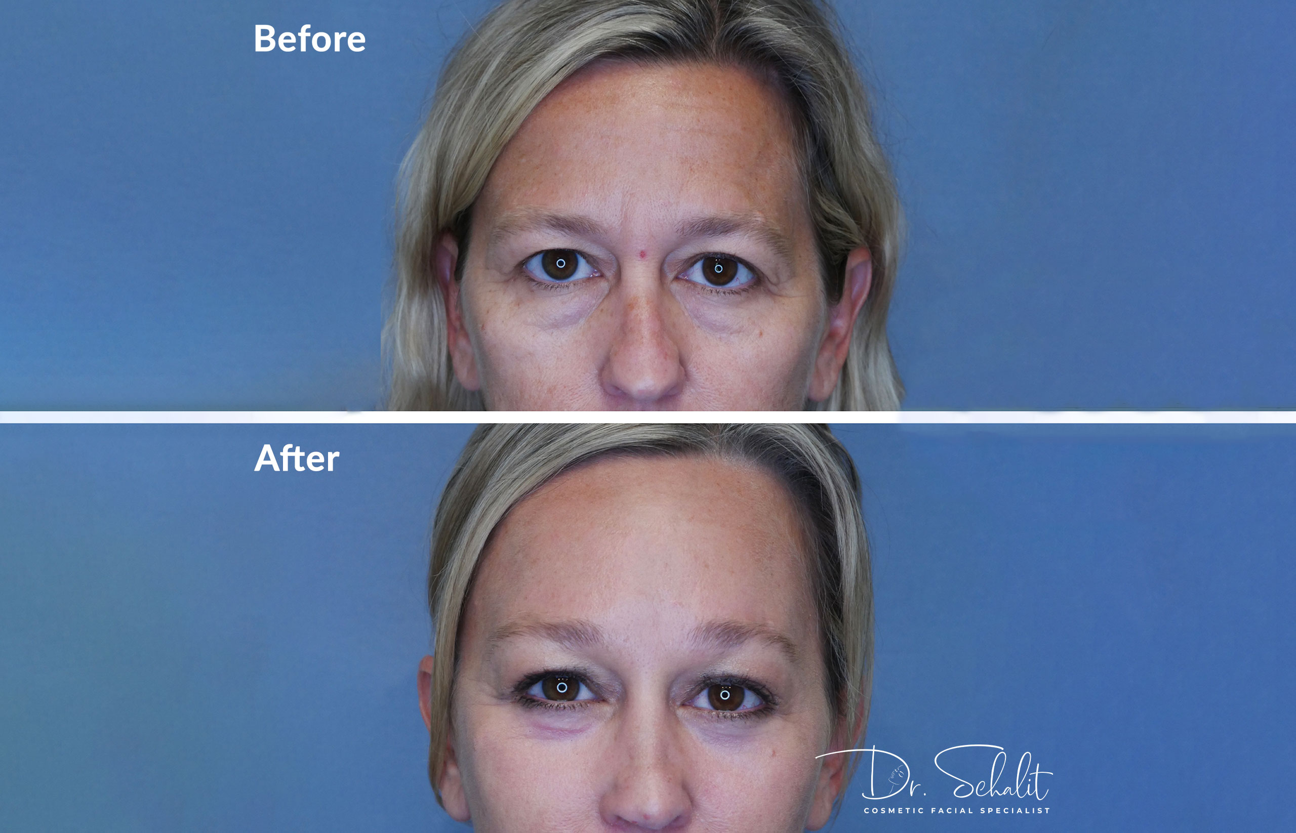 a woman's face before and after a facelift in Daytona Beach with Dr. Schalit.