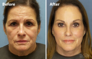 a woman's face before and after a facelift in Daytona Beach with Dr. Schalit.