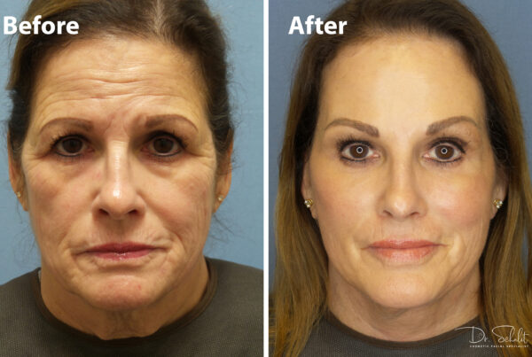 a woman's face before and after a facelift in Daytona Beach with Dr. Schalit.