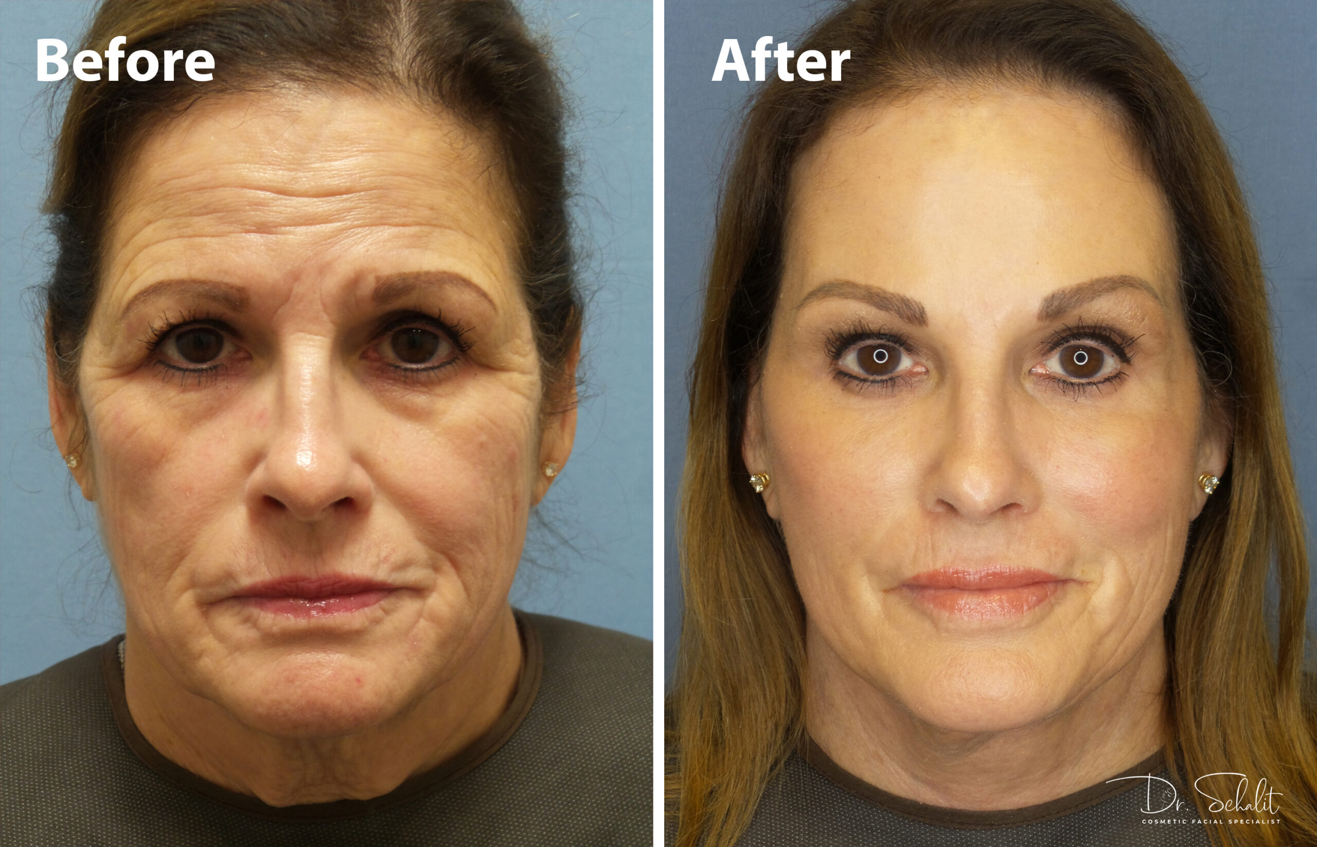 a woman's face before and after a facelift in Daytona Beach with Dr. Schalit.