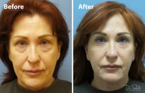 a woman's face before and after a facelift in Daytona Beach with Dr. Schalit.