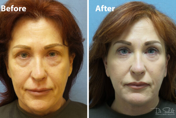 a woman's face before and after a facelift in Daytona Beach with Dr. Schalit.