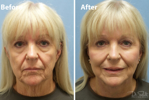 a woman's face before and after a facelift in Daytona Beach with Dr. Schalit.