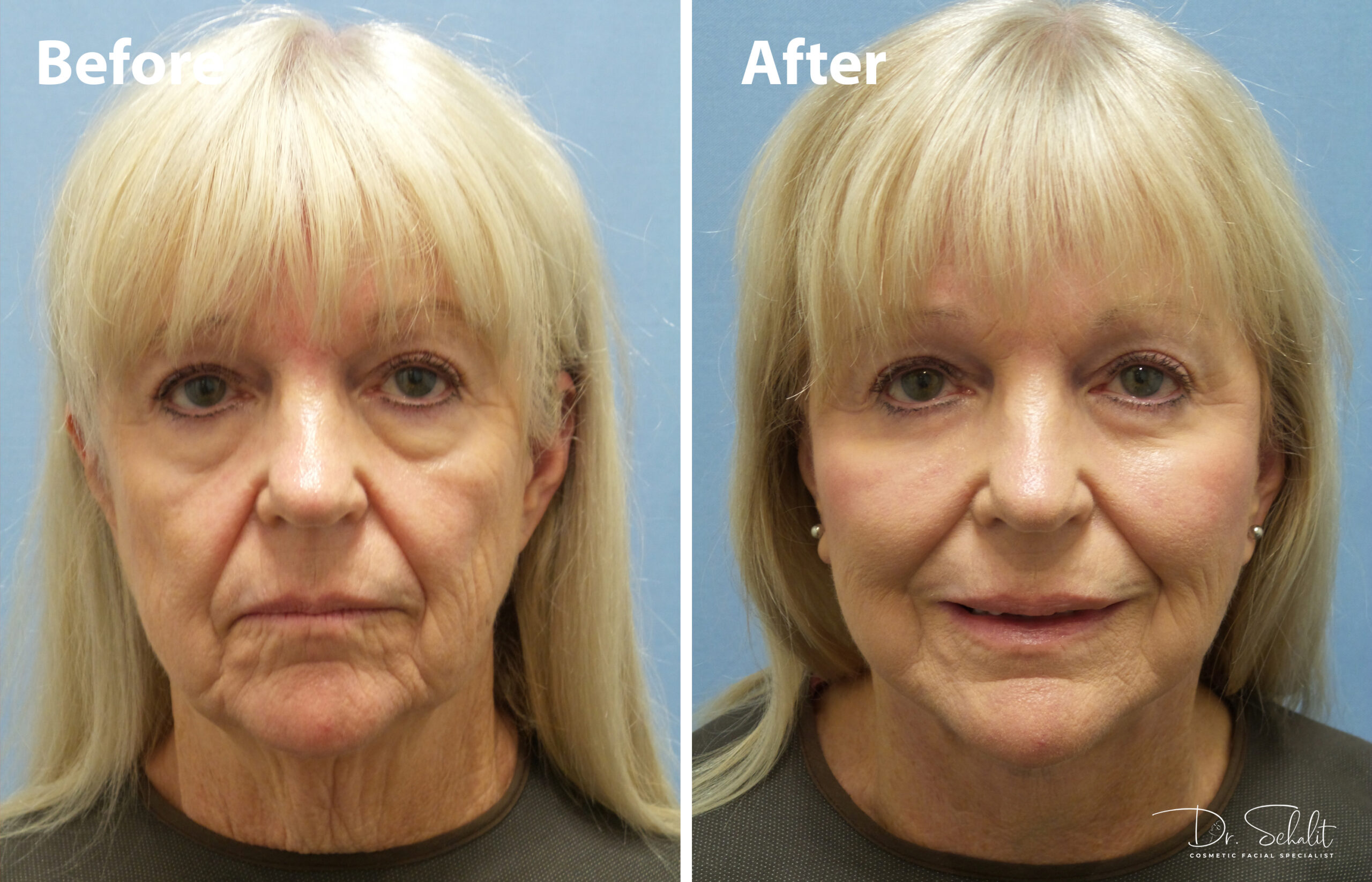 a woman's face before and after a facelift in Daytona Beach with Dr. Schalit.