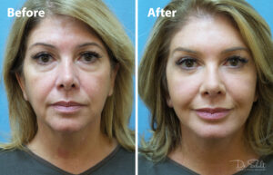 a woman's face before and after a facelift in Daytona Beach with Dr. Schalit.
