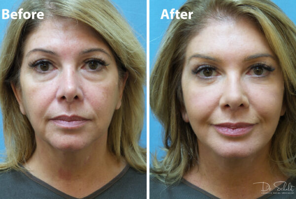 a woman's face before and after a facelift in Daytona Beach with Dr. Schalit.