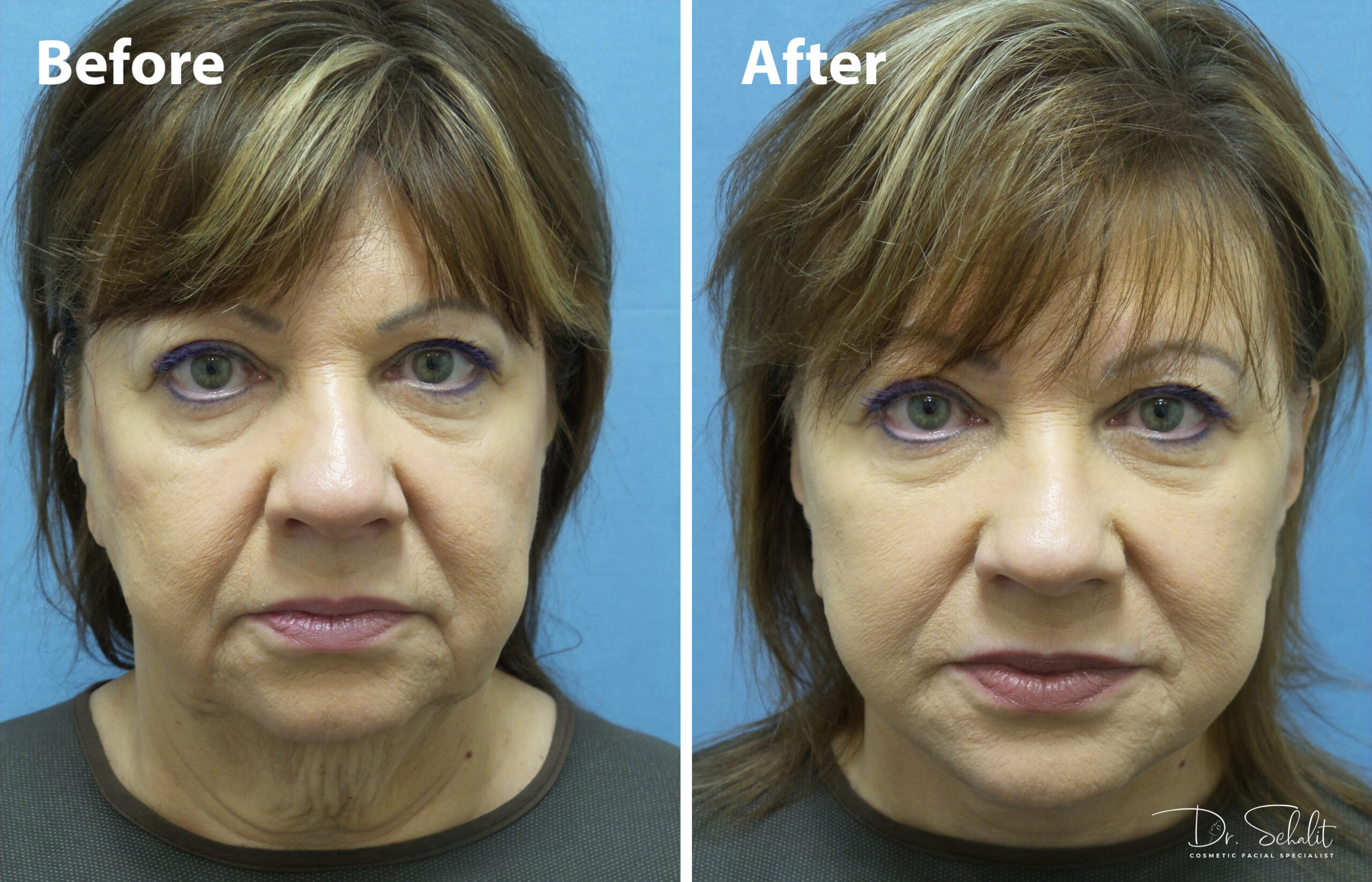 a woman's face before and after a facelift in Daytona Beach with Dr. Schalit.