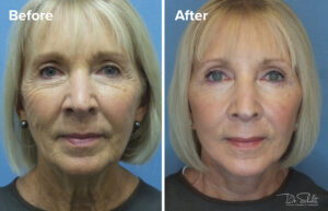 a woman's face before and after a facelift in Daytona Beach with Dr. Schalit.