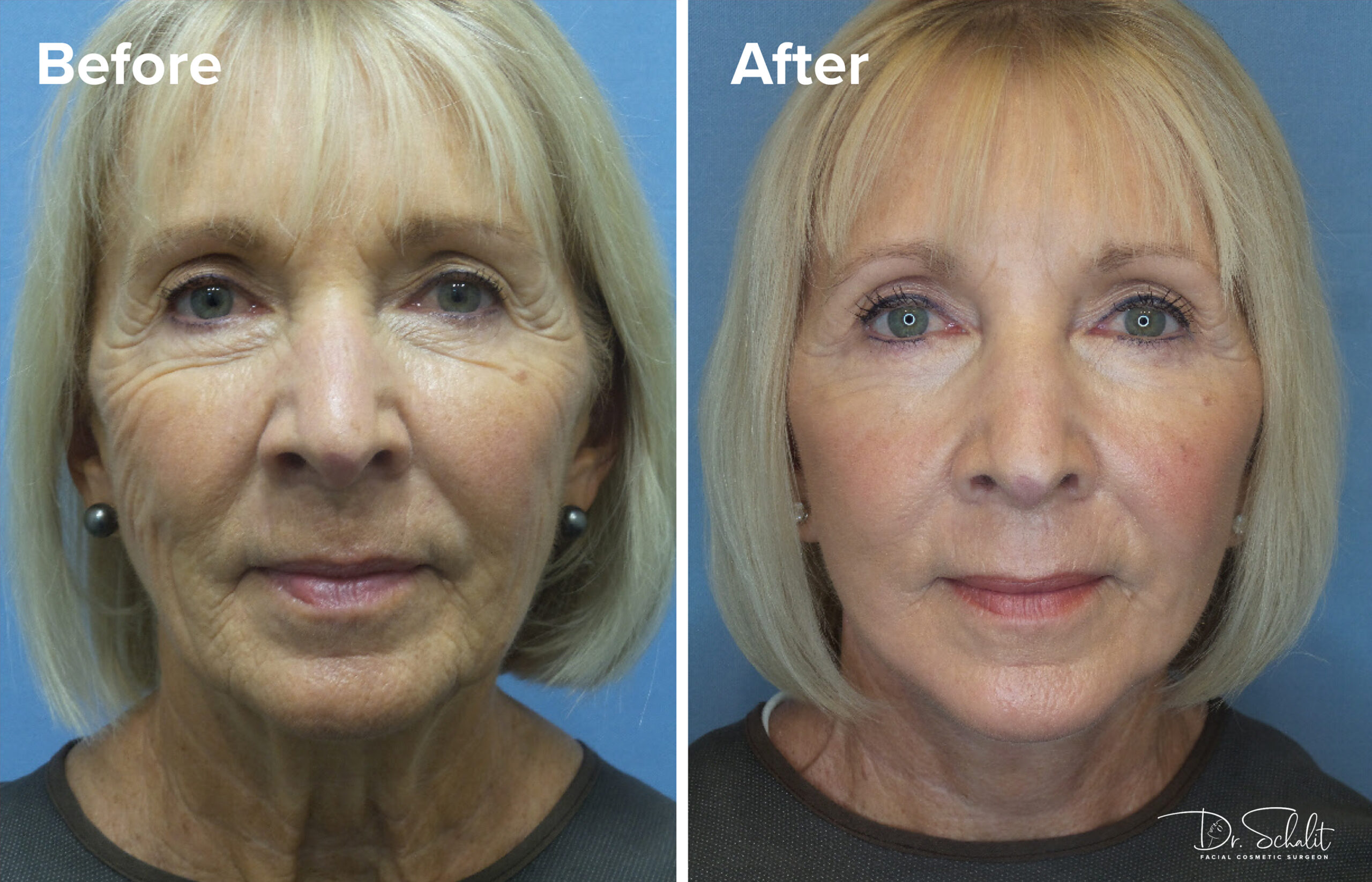a woman's face before and after a facelift in Daytona Beach with Dr. Schalit.