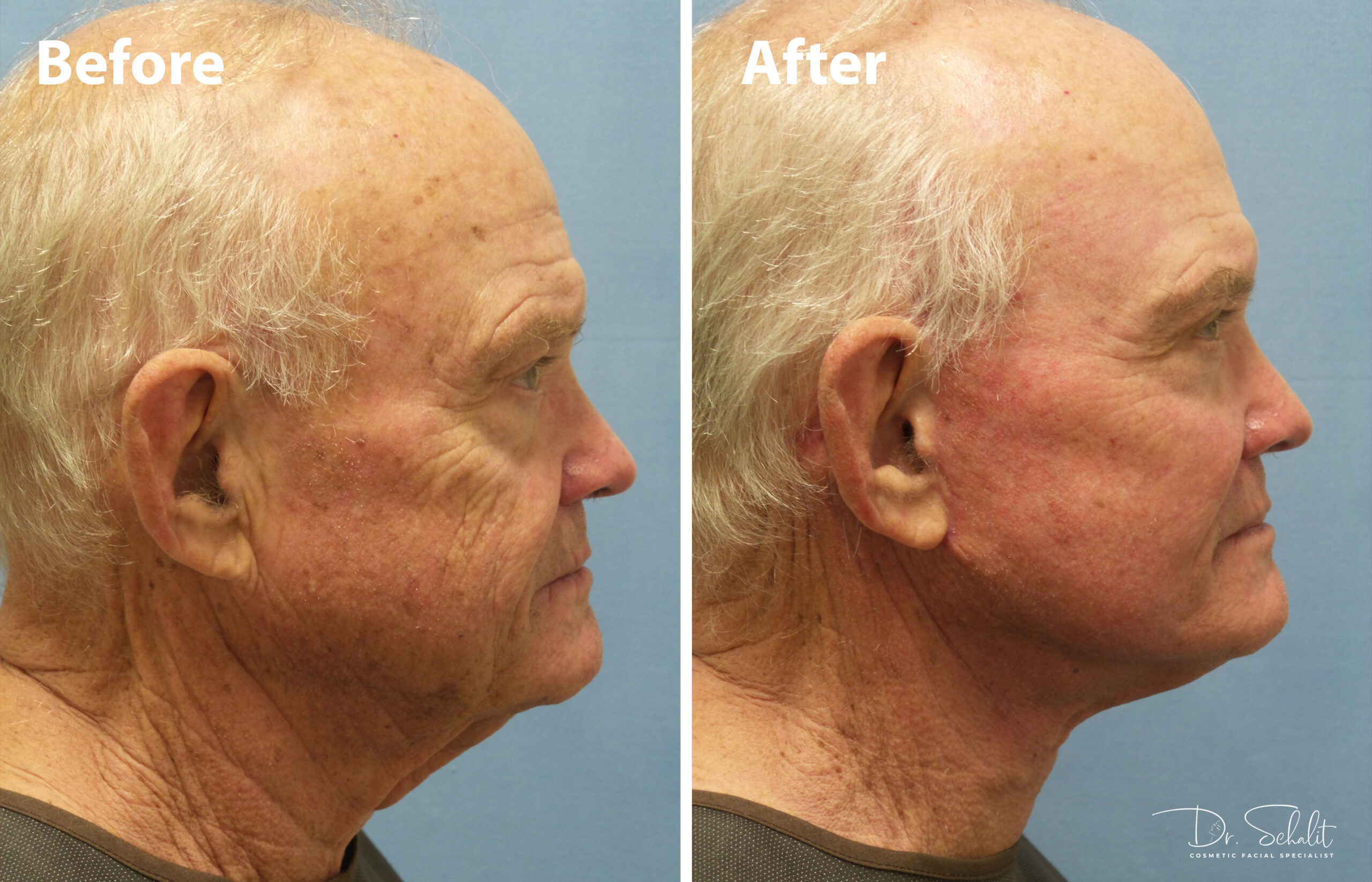 a man's face before and after a neck lift and facelift in Daytona Beach with Dr. Schalit.