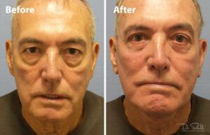 a man's face before and after a facelift in Daytona Beach with Dr. Schalit.