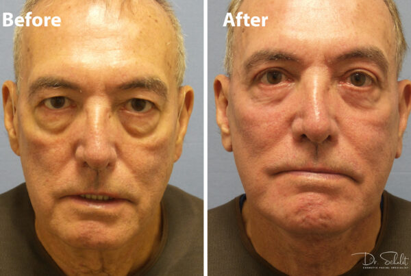 a man's face before and after a facelift in Daytona Beach with Dr. Schalit.
