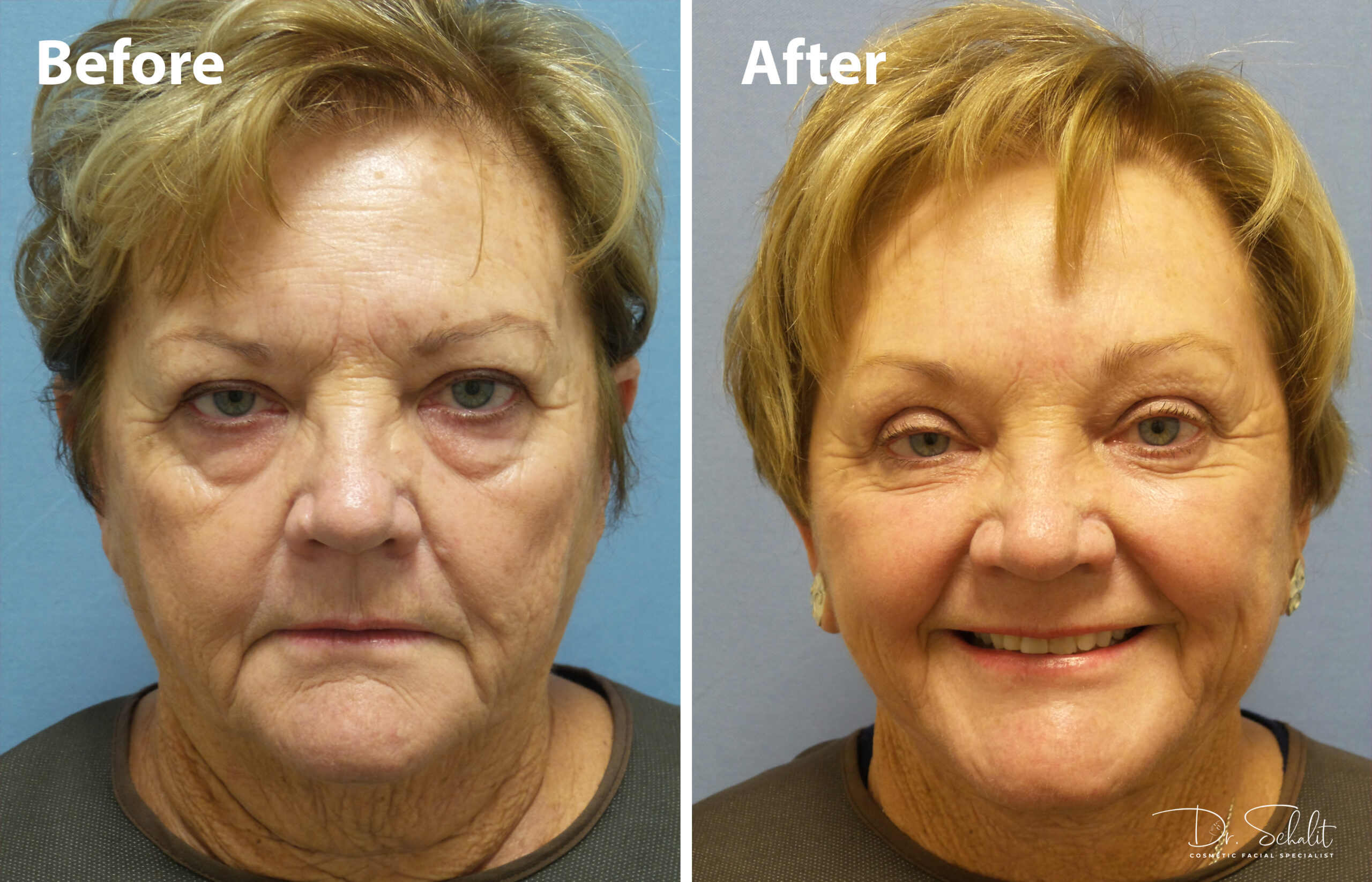 a woman's face before and after a facelift in Daytona Beach with Dr. Schalit.