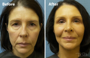 a woman's face before and after a facelift in Daytona Beach with Dr. Schalit.