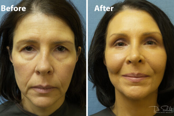 a woman's face before and after a facelift in Daytona Beach with Dr. Schalit.