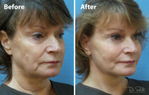 a woman's face before and after a facelift in Daytona Beach with Dr. Schalit.