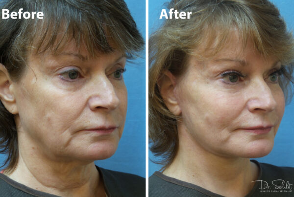 a woman's face before and after a facelift in Daytona Beach with Dr. Schalit.