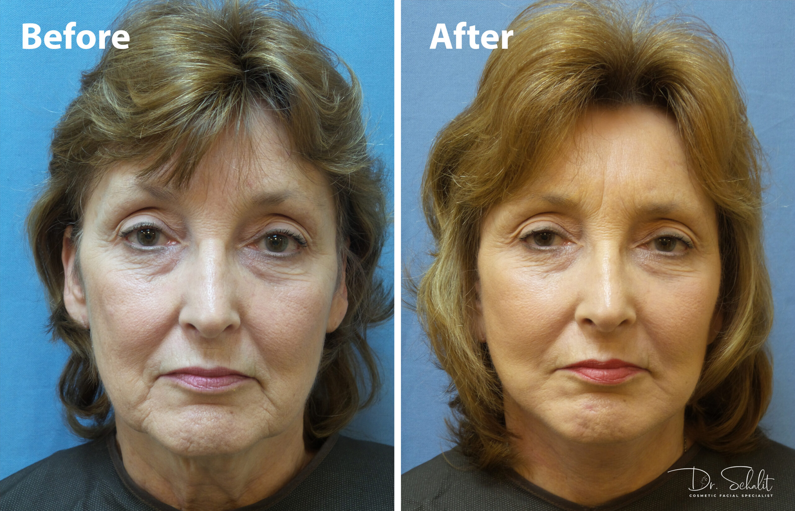 a woman's face before and after a facelift in Daytona Beach with Dr. Schalit.