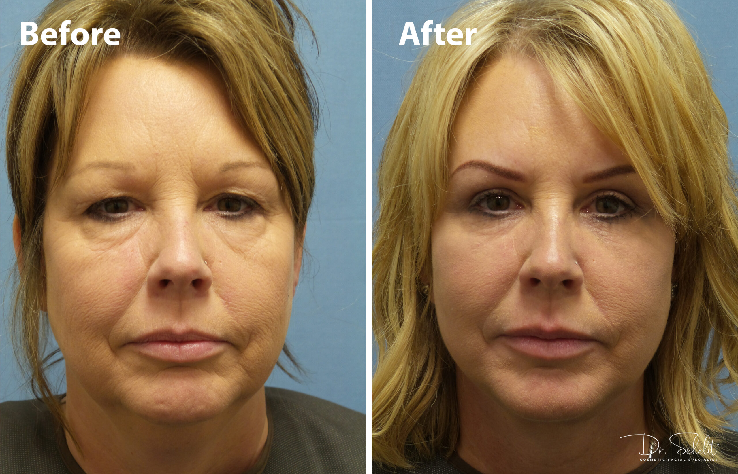 a woman's face before and after a facelift in Daytona Beach with Dr. Schalit.