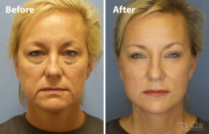 a woman's face before and after a facelift in Daytona Beach with Dr. Schalit.