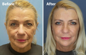 a woman's face before and after a facelift and neck lift in Daytona Beach with Dr. Schalit.