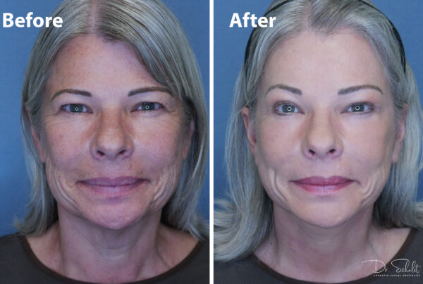 a woman's face before and after a facelift in Daytona Beach with Dr. Schalit.