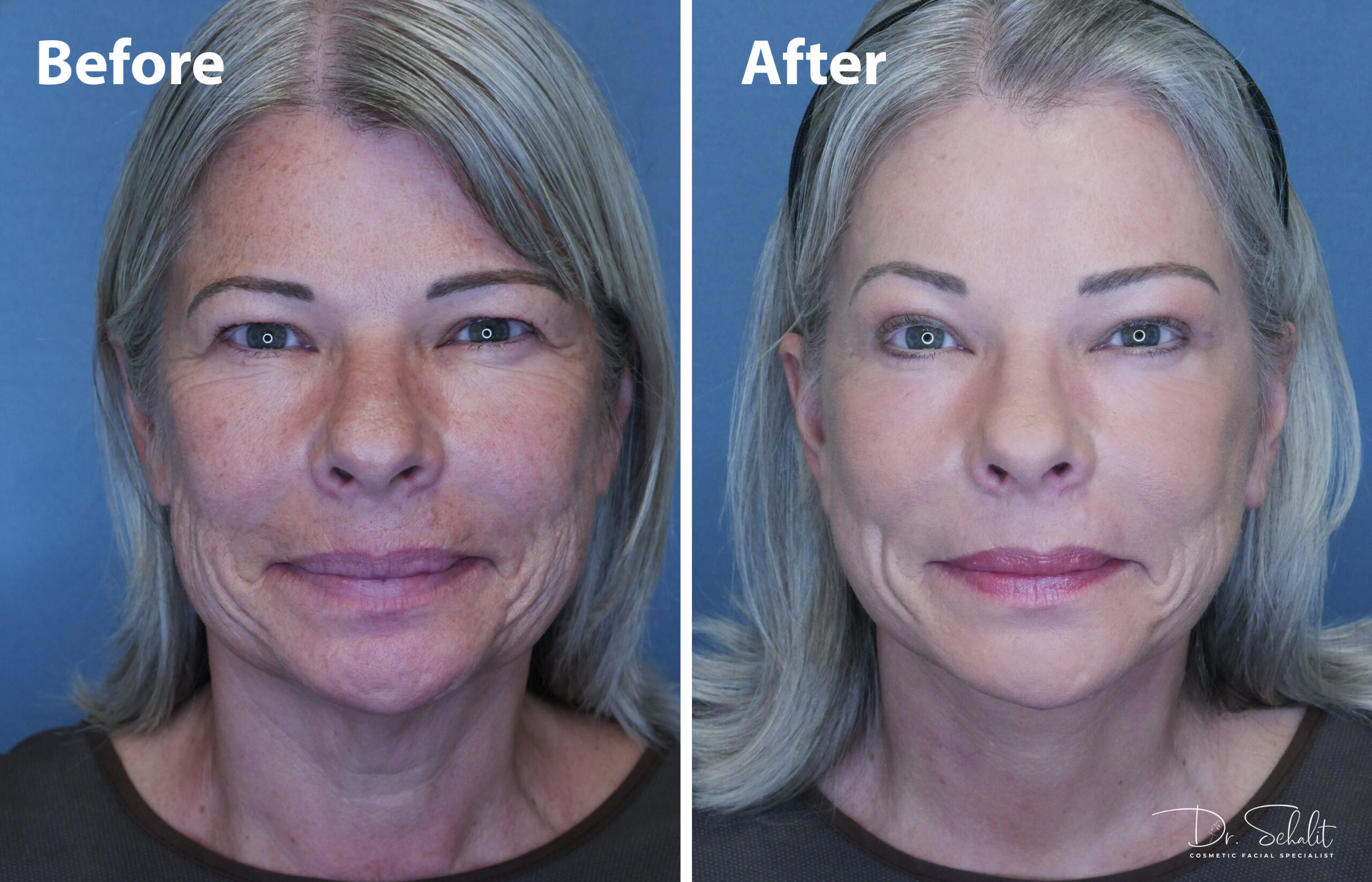 a woman's face before and after a facelift in Daytona Beach with Dr. Schalit.