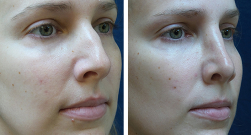 Before and After rhinoplasty in Daytona Beach
