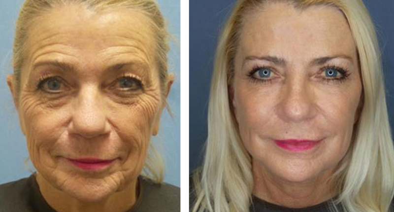 woman before and after facelift in Daytona Beach