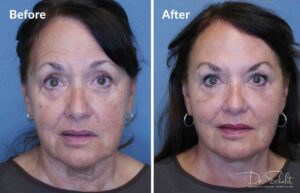 a woman's face before and after a facelift in Daytona Beach with Dr. Schalit.