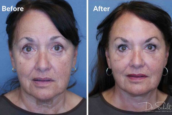 a woman's face before and after a facelift in Daytona Beach with Dr. Schalit.