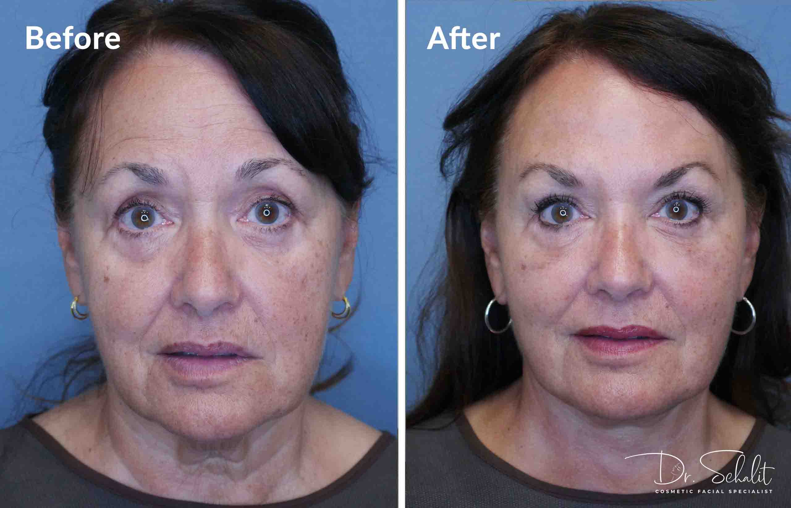 a woman's face before and after a facelift in Daytona Beach with Dr. Schalit.
