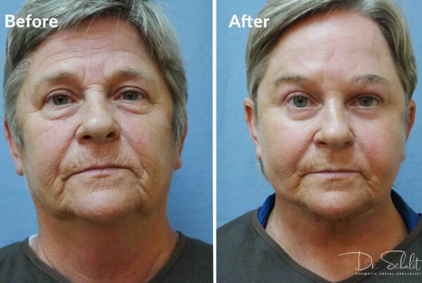 a man's face before and after a facelift in Daytona Beach with Dr. Schalit.
