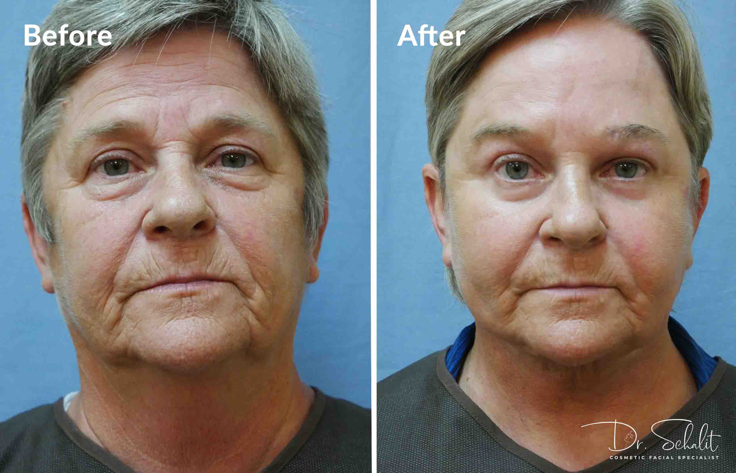 a man's face before and after a facelift in Daytona Beach with Dr. Schalit.