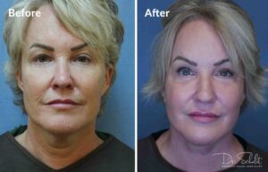 a woman's face before and after a facelift in Daytona Beach with Dr. Schalit.