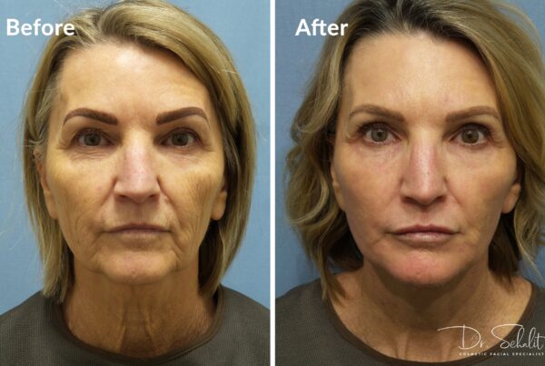 a woman's face before and after a facelift in Daytona Beach with Dr. Schalit.