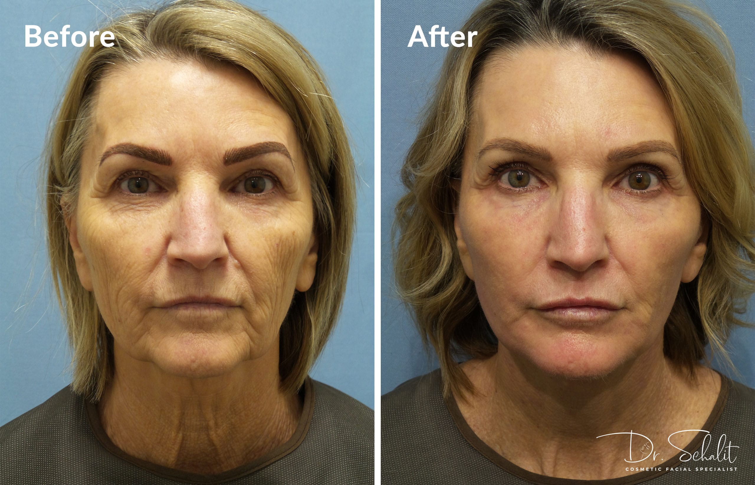 a woman's face before and after a facelift in Daytona Beach with Dr. Schalit.