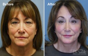 a woman's face before and after a facelift in Daytona Beach with Dr. Schalit.