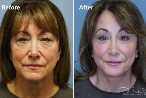 a woman's face before and after a facelift in Daytona Beach with Dr. Schalit.