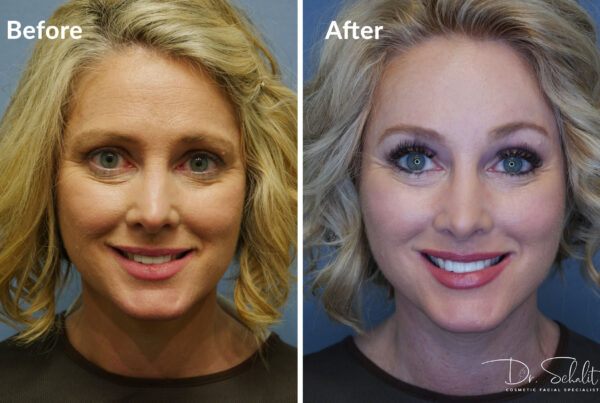 a woman's face before and after a facelift in Daytona Beach with Dr. Schalit.