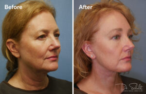 a woman's face before and after a facelift in Daytona Beach with Dr. Schalit.