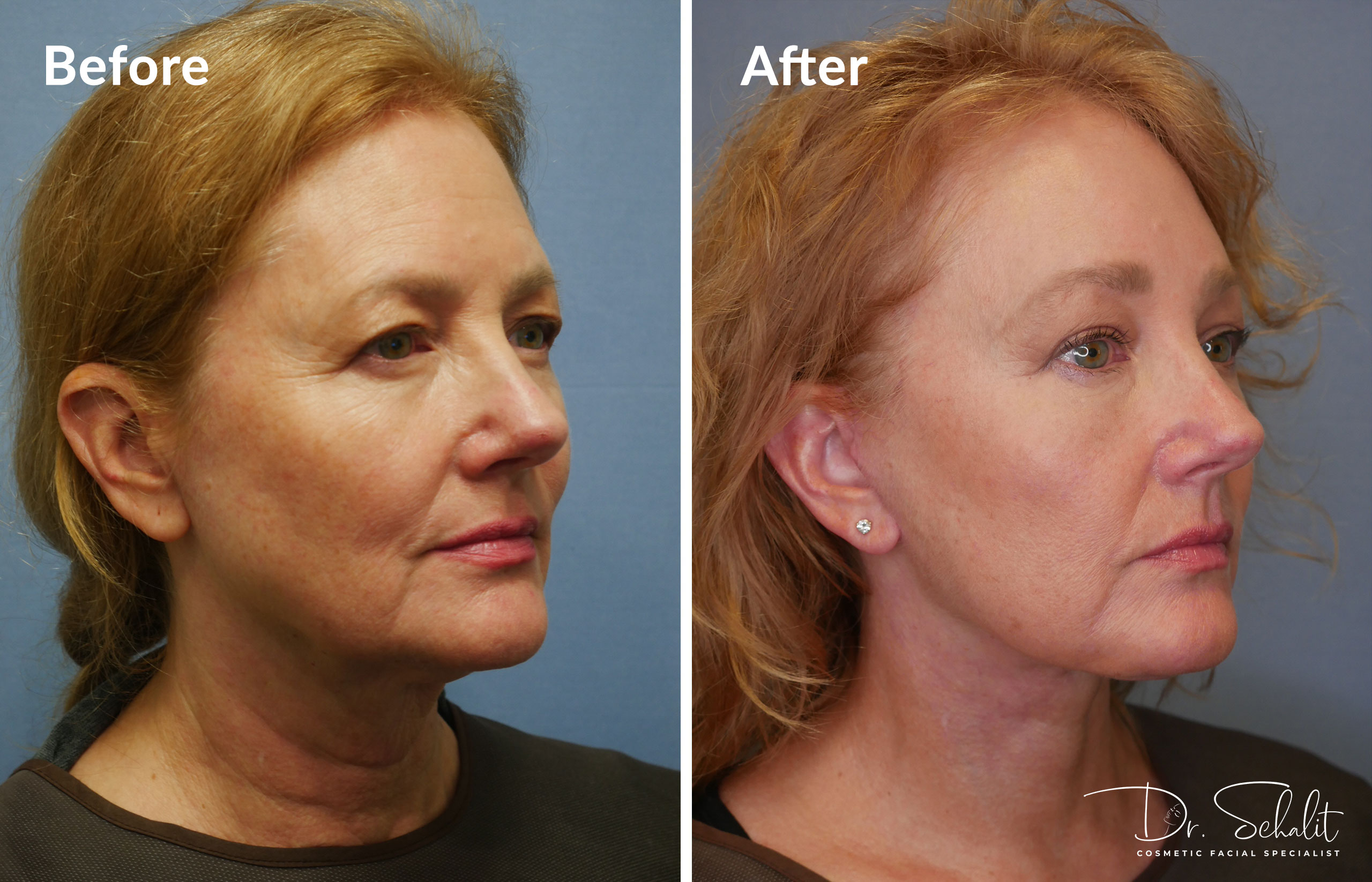 a woman's face before and after a facelift in Daytona Beach with Dr. Schalit.