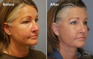 a woman's face before and after a facelift in Daytona Beach with Dr. Schalit.