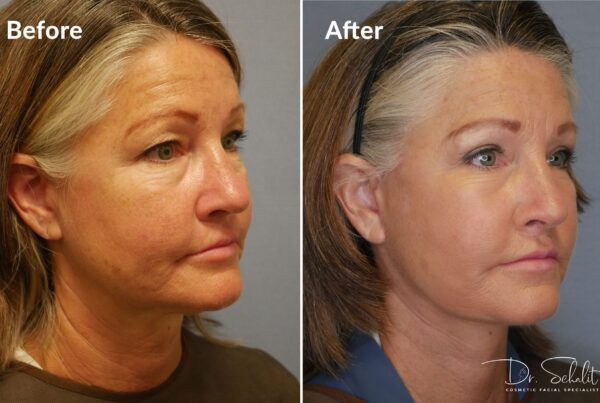 a woman's face before and after a facelift in Daytona Beach with Dr. Schalit.