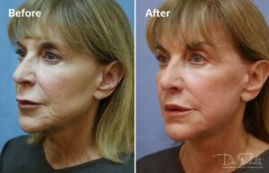 a woman's face before and after a facelift in Daytona Beach with Dr. Schalit.
