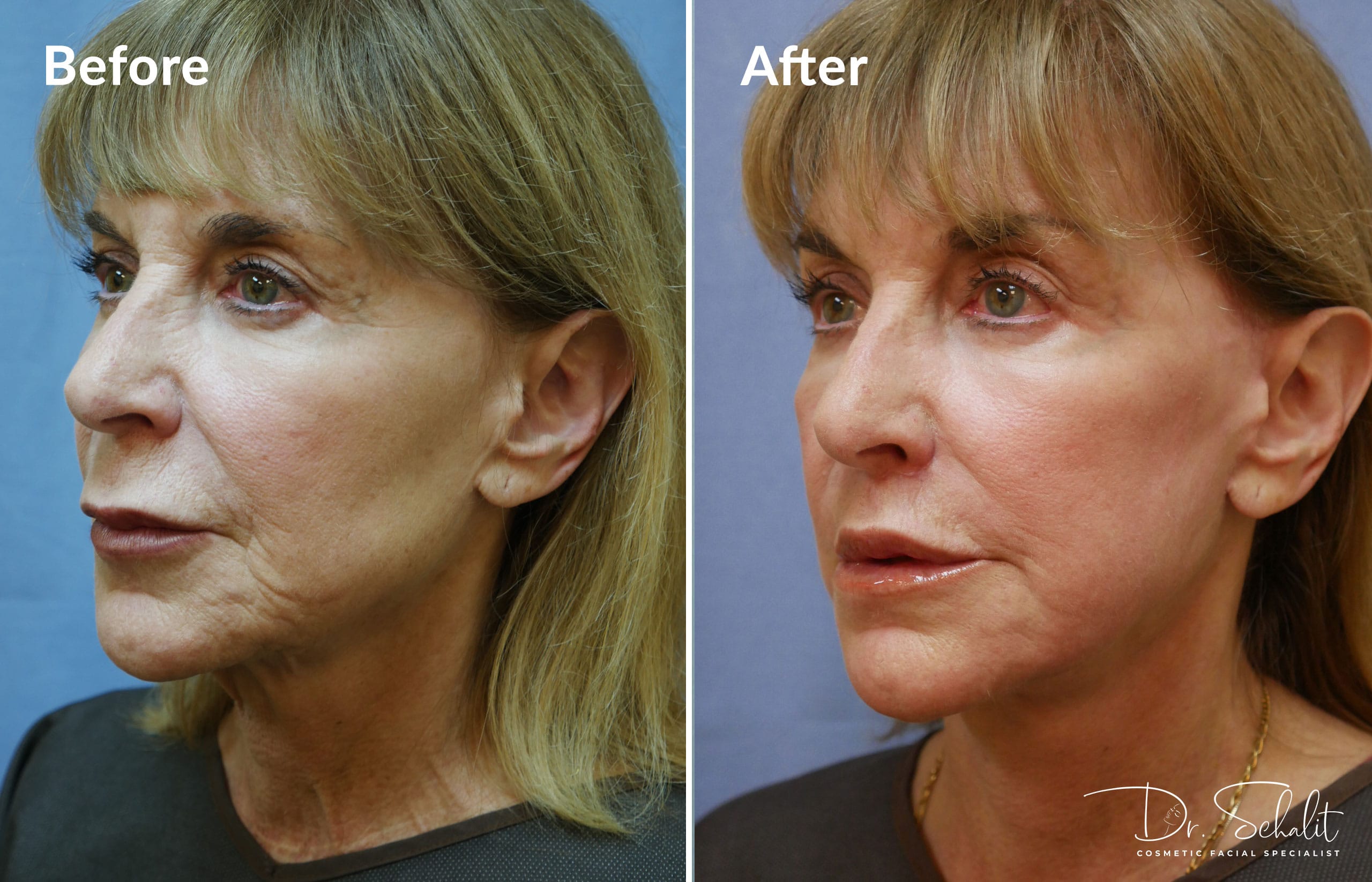 a woman's face before and after a facelift in Daytona Beach with Dr. Schalit.